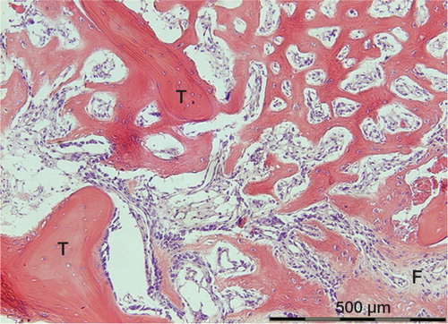 Figure 3. Woven bone in the marrow connecting to old trabeculae (T). Formation is still continuing at the lower right-hand corner (F). The same patient as in Figure 2.