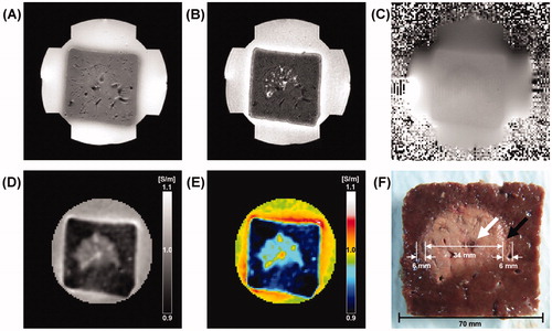 Figure 3. Typical MREIT images of ablated liver tissue with a power of 50 W following 3 min of exposure time. (A, B) T1-, T2-weighted MR images of ablated liver tissue. (C) A magnetic flux density image induced by the horizontal injection current. (D, E) Reconstructed conductivity and colour-coded conductivity images of ablated liver tissue showing a significantly increased contrast and well-defined lesions. (F) A photograph of ablated liver tissue at the same imaging slice. The arrows indicate the coagulation necrosis (white arrow) and the hyperaemic rim (black arrow).