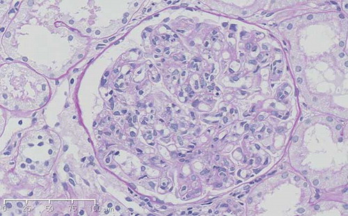 Figure 1.  Light microscopy findings. Light microscopy shows a glomerular lesion that was enlarged and hypercellular (PAS staining, original magnification ×200).
