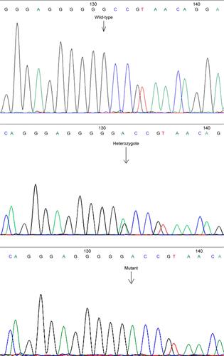 Figure S2 DNA sequencing analysis of a wild-type GG, a heterozygote G/T, and a mutant TT around the CD14 C260T SNP area (reverse primer).Abbreviation: SNP, single-nucleotide polymorphism.