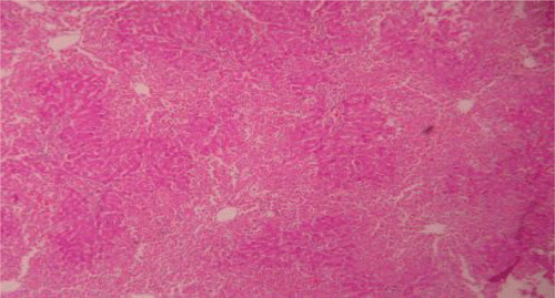 Figure 3.  Liver section of silymarin and paracetamol rats shows moderate necrosis, moderate ballooning degeneration and little infiltration of lymphocytesries.