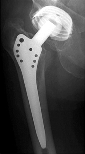 Figure 11. Radiograph of a Zweymüller stem (type Hochgezogen) with the CSF cup in a 69-year old man more than 21 years after the index operation with no evidence of loosening but showing polyethylene wear.