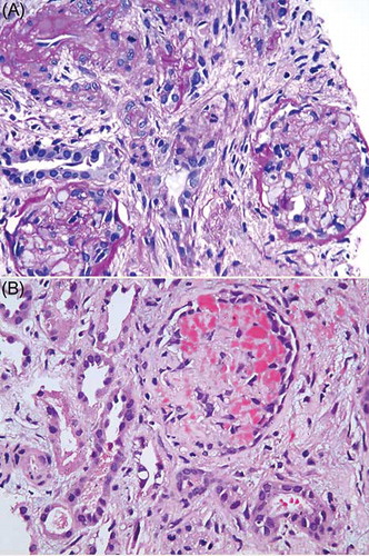 Figure 1.  Photomicrograph shows (A) glomerular and tubular necrosis and (B) fibrin in the glomerular capillary loops (H&E, ×200). Both panels show interstitial fibrosis.