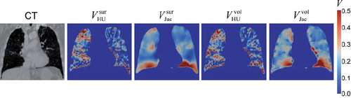 Figure 3. Example coronal images at the same level of peak-exhale CT and 4D-CT ventilation derived from the different combinations of two deformable image registration algorithms: surface-based registration and non-parametric volume-based registration, and two ventilation metrics: Hounsfield unit (HU)-change and Jacobian determinant of deformation.