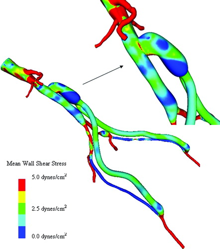 Figure 13. Mean wall shear stress for AFB model. Regions of low mean wall shear stress (shown in blue) are theorized to be sites of high risk for the development of atherosclerosis or neointimal hyperplasia.