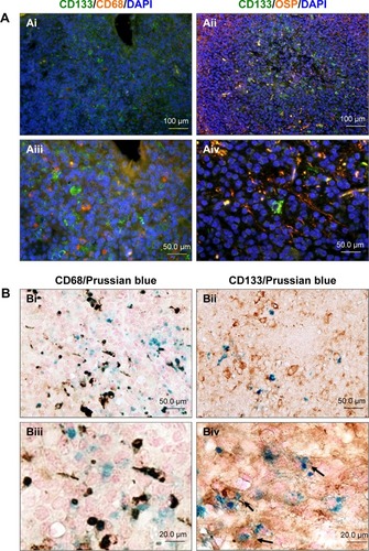 Figure 7 USPIO-CD133 Ab specifically targeted to ENU-induced rat brain tumor cells.Notes: (A) Immunofluorescence staining of CD133 expression in microglia (CD68) and oligodendrocytes (oligodendrocyte-specific protein; [OSP]) of ENU-induced rat brain tumors was observed under fluorescent microscope at 200× (Ai and Aii) and 400× (Aiii and Aiv) magnification. (B) Detection of CD68 and CD133 expression in USPIO-CD133 Ab labeled cells of ENU-induced rat brain tumors. Double staining of CD133 (brown) and USPIO-CD133 Ab (Prussian blue staining) cells (indicated with arrows in Biv) are shown in the brain sections at 400× (Bi and Bii) and 1,000× (Biii and Biv) magnification.Abbreviations: DAPI, 4′,6-diamidino-2-phenylindole; ENU, N-ethyl-N-nitrosourea; USPIO-CD133 Ab, ultrasmall superparamagnetic iron oxide conjugated with anti-CD133 antibodies.