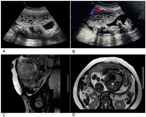 Figure 1. Results of imaging studies performed at 31 weeks. (A,B) Ultrasound appearance of the pregnancy, and the molar component. (C) Sagittal MRI image. (D) Transverse MRI image.