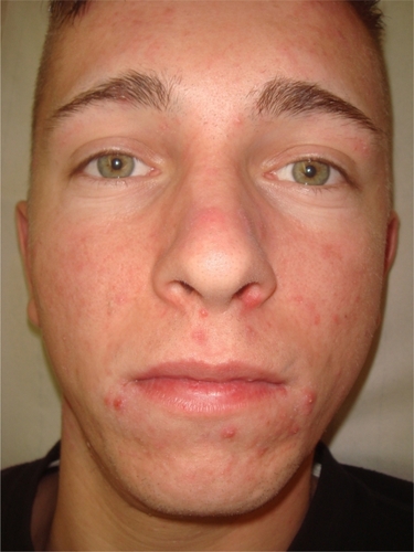 Figure 1A Acne treatment by capryloyl salicylic acid peel (22-year-old male) prior to treatment.