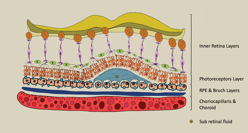Figure 1. Graphic representation of the retina layers with sub retinal fluid in CSC context.