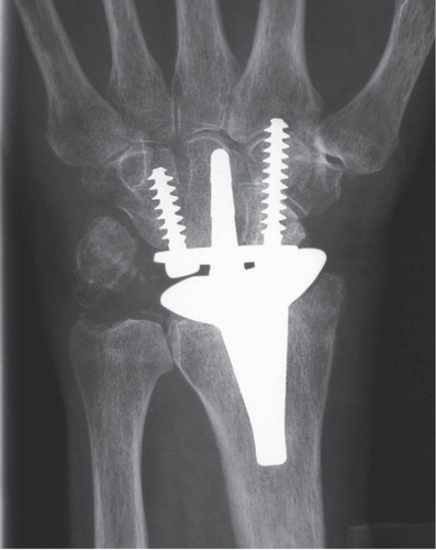 Figure 2. Frontal radiograph of the Re-motion TWA in a 75-year old woman with primary osteoarthrosis.