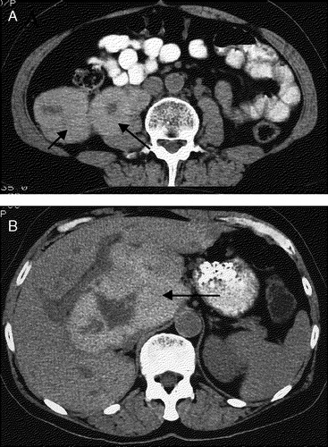 Figure 2.  Metastatic sites (March 1996). a: Retroperitoneal tumour masses (arrows), b: Metastasis to lobus caudatus hepatis (13×8 cm).
