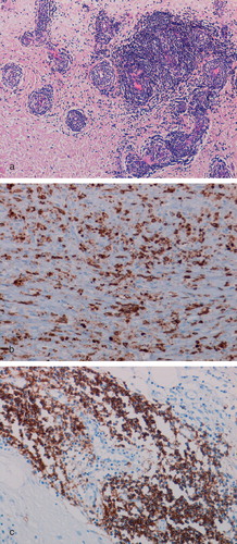 Figure 4.  Pseudomembrane from a case of MoM implant component loosening showing (a) numerous perivascular lymphoid aggregates and a diffuse lymphocyte infiltrate; (b) expression of CD3 by lymphocytes in the diffuse inflammatory cell infiltrate; and (c) CD20-expressing B lymphocytes in lymphoid aggregates.