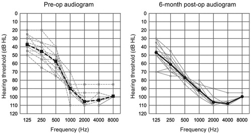 Figure 2. Average air-conduction hearing thresholds. The dashed and solid lines indicate pre- and 6 months post-op, respectively. Gray and black lines show the individual and mean, respectively.