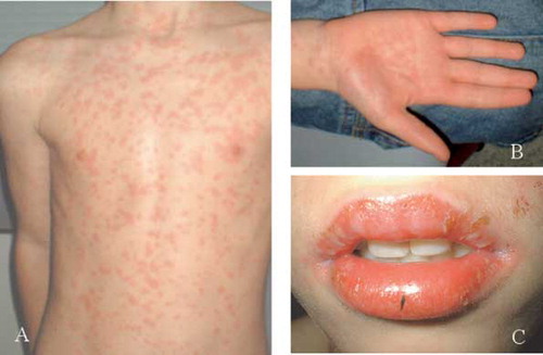 Fig. 1.  The pruritic rash started in the patients trunk evolved to confluent maculae (A) and spread all over the patient's body, including the palms of his hands (B). He had crustae and blisters on his lips and oral mucosa (C).