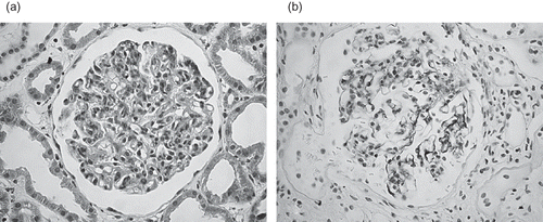 FIGURE 1. (a) Patient 1: Light microscopy. (b) Patient 2: Immunostaining highlighted granular capillary loops with IgG, IgM, C3, and C1q.