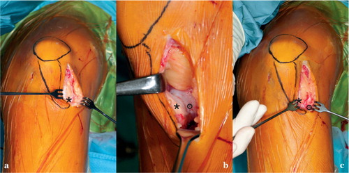 Figure 1. a. Lateralized left patella tendon shown through incision. * lateral fixed patellar ligament.b. The patella tendon dissected sharply from the tibial tuberosity. Then the periosteum gets detached from the tibial crest by using a rasp (° tibial tuberosity, * patellar ligament).c. New medialized position of the patella tendon through the incision (° tibial tuberosity, * detached patellar ligament).