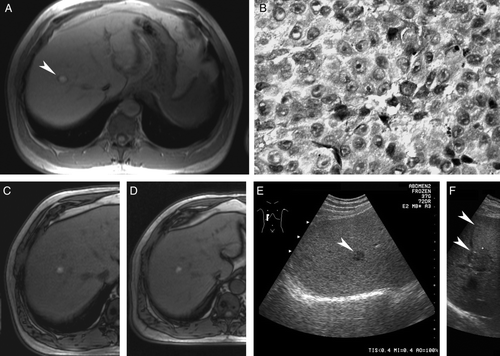 Figure 1.  Liver metastasis from uveal melanoma. Magnetic resonance imaging (MRI) shows a solitary 20 mm target lesion (arrowhead) in the right lobe of the liver (A). Core needle biopsy confirms metastatic melanoma (B; hematoxylin-eosin). MRI documents partial response after the 3rd (C) cycle, maintained after the 9th cycle and subsequent interferon monotherapy (D). Same lesion seen with ultrasonography before (E; arrowhead) and after (F) adjuvant thermoablation (small crosses) with the ablated needle track (arrowheads).