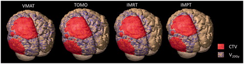 Figure 2. Three-dimensional representations of the cerebrum and cerebellum of a LGG patient highlighting the CTV in red and the 20 Gy isodose (purple/brown) of the different treatment techniques studied (VMAT, TOMO, IMRT and IMPT).