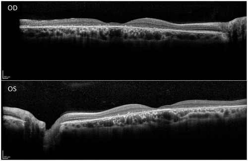 FIGURE 3. Spectral domain optical coherence tomography line scans (right eye top and left eye bottom, corresponding to the location of the horizontal lines on the near-infrared autofluorescence images in Figures 2G and H, respectively) show intact RPE at the foveola in the presence of marked foveal thinning, surrounded by atrophy of the outer retinal layers and retinal pigment epithelium, with relatively more normal retinal structure at the margins of the line scans in both eyes.