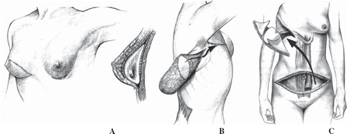 Figure 1. Three methods of breast reconstruction. A. with a submuscular implant. B. with a latissimus dorsi flap (LD flap). C. with a pedicled transvers rectus musculocutaneous flap (TRAM flap). Courtesy Department of Clinical Photo, Aarhus University Hospital, Denmark.