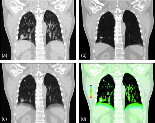 Figure 4.  Frontal reconstruction of 4DCT scans in a patient with two tumors in the right lung. Images illustrate the respective maximum intensity projection (a), minimum intensity projection (b), mean intensity projection (c), and color intensity projection (d) protocols for this 4DCT study.