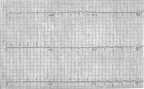 Figure 3. EKG after rewarming with hemodialysis showing resolution of Osborn waves.
