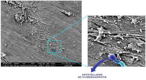 Figure 12 Scanning electron micrographs of bone defects filled with nano-hydroxyapatite/ß tricalcium phosphate showing bone matrix surface, highlighting hydroxyapatite crystals (light and dark blue) in contact with proteinaceous matrix component. Scale bar = 50 µm, x500 magnification. Magnified image = Scale bar = 20 µm, X 2375.