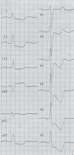 Figure 1. ECG (50 mm/s) shows the global ischemia ECG pattern: ST depression and inverted T waves maximally in leads V4–5 and ST elevation in lead aVR.