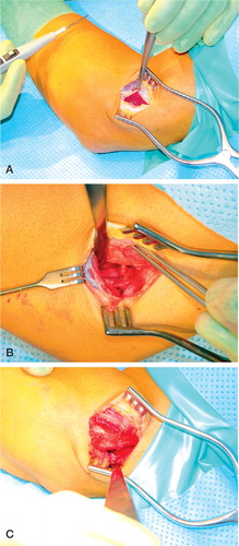 Figure 2. A.The lateral incision. B. Anterior capsule release. C. Posterior capsule release.
