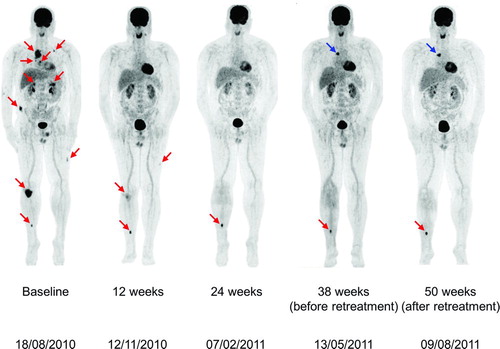Figure 1  Coronal maximal-intensity-projection PET whole body scans obtained at baseline and Weeks 12, 24, 38, and 50 during therapy with ipilimumab 3 mg/kg in Patient A. Melanoma metastases are indicated by red arrows. At baseline, scans showed metastatic muscular, lymph node, lung, intestinal, and bone lesions. A Week 12 assessment showed a rapid response with regression of most of the metastatic sites. Only a muscular metastasis in the upper left leg and the bone metastases in the right knee and tibia remained 18FDG-avid. At Week 24, there was a disappearance of the muscular upper left leg metastasis and the skeletal knee metastasis became 18FDG-negative. At Week 38, there was a reappearance of metastatic mediastinal lymph nodes (blue arrow) and the patient was given retreatment therapy with ipilimumab. Repeat scans after retreatment showed a stabilisation of the mediastinal lymph node and bone (right tibia) metastases.