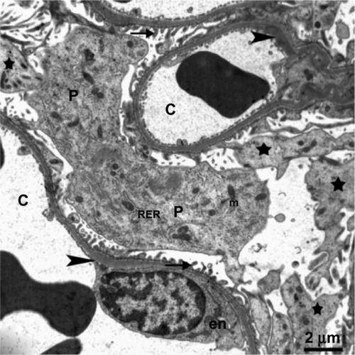 Figure 9 Transmission electron micrograph of kidney glomerular tissue from the treated group showing swollen podocytes with numerous long primary (stars) and secondary processes (arrows) rich in organelles, mitochondria, rough endoplasmic reticulum, and thickening of the basement membrane (arrowhead) in the capillary tuft. The body of an endothelial cell (en) can be seen. Scale bar 2 μm.Abbreviations: C, capillary; en, endothelial cell; m, mitochondria; P, podocytes; RER, rough endoplasmic reticulum.