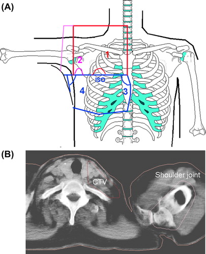 Figure 1. A. Schematic display of the four-field arrangement used in CT-RT. The red field borders depict the anterior-posterior field (1), the pink color indicated the oblique filed (2), and the blue color illustrates the location of the tangential fields (3 and 4). B. Delineated shoulder joint on the planning CT-images.