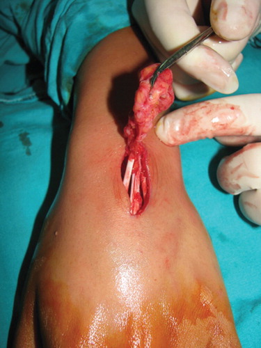 Figure 2. Intraoperative view of the angiofibrolipoma.