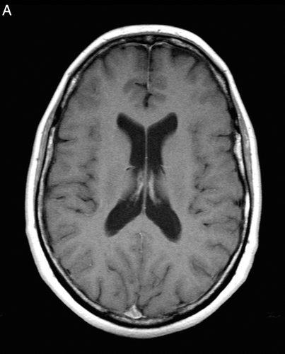 Figure A.  Axial T1 MRI with contrast shows no evidence of a brain tumor.