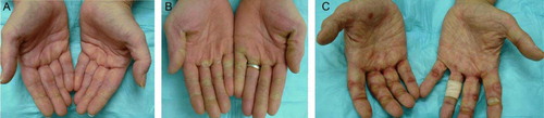 Figure 5.  Example of grades I (A), II (B), III (C) hand-foot skin reaction (HFSR) in patients receiving sorafenib.