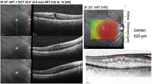 Figure 3 Spectral domain-optical coherence tomography of a right eye affected by diabetic macular edema (ME). Spongy aspect of neuroretin (central thickness of 520 µm) and hyperreflectivity of epiretinal membrane.