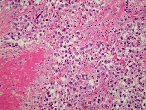 Figure 3.  Paraspinal tumor. The clear cell sarcoma is comprised of polygonal cells with abundant clear to pale cytoplasm bordered by thin fibrous septae. A small amount of associated necrosis is seen in the lower left hand corner. (H & E section, 200X)