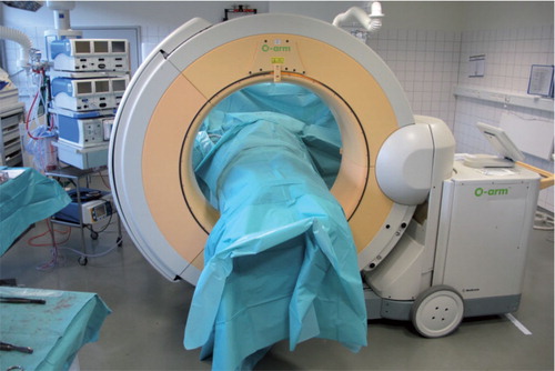 Figure 1. The unsterile O-arm closed around the patient for an intraoperative 3D scan. The patient is draped with 2 sterile drapings, which are removed after scanning so that sterility is not jeopardized.