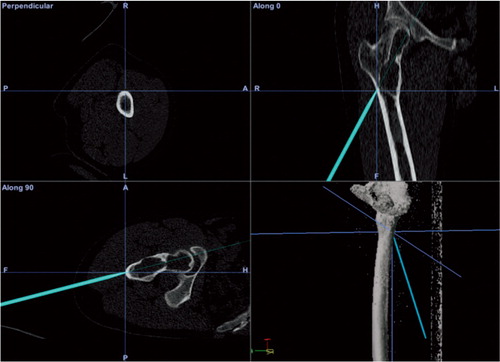 Figure 3. A screen shot acquired on the CAS system during curettage. Patient information has been digitally edited out. The case was a 31-year-old patient with fibrous dysplasia of the femoral head. The location was such that there was a risk of damaging the cartilage on the femoral head during curettage, potentially invalidating the patient. The cavity was filled with PMMA. Weight bearing was 50% in the first 6 weeks, gradually increasing to full in the 6 weeks that followed.