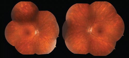 FIGURE 1  Fundus photographs taken in November 2010 showing classic white ovoid hypopigmented spots classic for birdshot retinopathy.