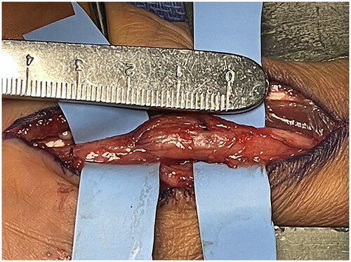 Figure 6. Intraoperative image of the left wrist. The median nerve is positioned on a background with fibrolipomatous hamartoma demonstrated next to the measuring utensil. Neurolysis of the epineurium has been performed and the mass is seen to be intimately associated with the underlying fascicles preventing excision.