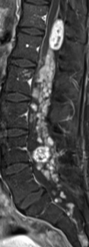 Figure 1. MRI of lumbar spine before treatment with bevacizumab.