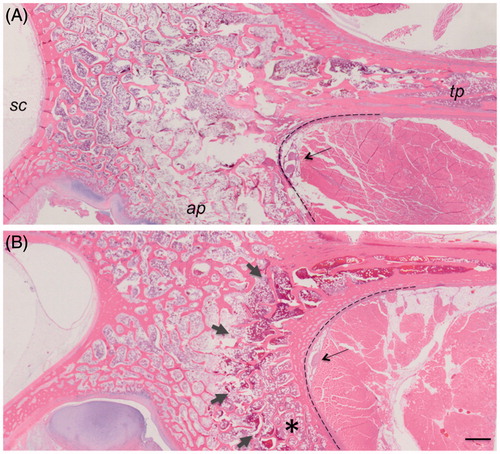 Figure 7. Low magnification images of haematoxylin and eosin histology from the acute (A) and subacute (B) studies. The dark red rim of haemorrhage (short arrows) visible at the surface of the bone between the articular process (ap) and transverse process (tp) made thermal lesions readily visible in subacute cases, compared to the acute cases. Changes in bone do not reach the spinal canal (sc). The nerve is shown with a long arrow. The dashed line delineates the interface between the bone and muscle. 1 mm scale bar.