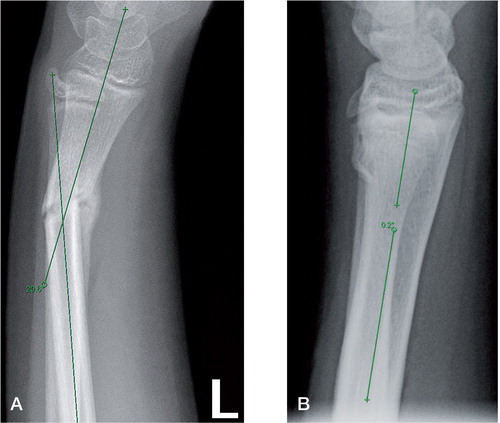 Figure 2. Case 28. A. Measurement of the starting malunion angle as described by CitationHansen et al. (1976). B. Measurement of the final malunion angle. New buckle fracture is present.