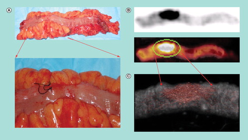 Figure 2. (A) Digital photograph of a resected sigmoid colon specimen with magnified region of interest. Suture placed at suspected tumor site based on intraoperative palpation and γ-probe detection. (B) Fused 18F-fluorodeoxyglucose PET/CT image of the resected sigmoid colon specimen. (C) Micro-PET/CT image of the specimen illustrates intense hypermetabolic activity at the tumor site and with only diffuse tracer uptake in the surrounding normal colon tissue.