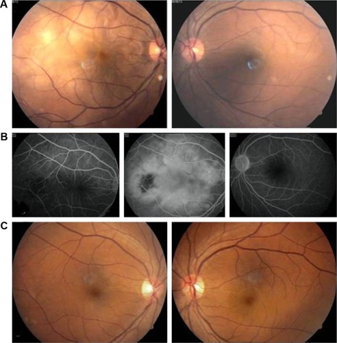 Figure 3 (A and B): Unilateral VKH. A 31-year-old female patient with BCVA RE 20/400 and LE 20/20 shows multiple serous retinal detachments, with multiple pinpoint leaks and subretinal pooling of dye. LE shows normal fundus with normal FFA. (C) Follow-up after 40 months shows both eyes normal fundus with BCVA RE 20/25 and LE 20/20.