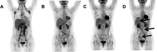 Figure 1 The baseline 18F-FDG PET/CT (A) image showed hypermetabolic lesions with TLG of 2,366.61. I-PET (B) after four cycles of R-CHOP therapy, and E-PET (C) after end-of therapy showed no hyper-metabolic lesions. After 11 months of therapy, the patient experienced relapse. 18F-FDG PET/CT (D) showed increased 18F-FDG uptake in the liver, abdomen and right pelvic (arrows).