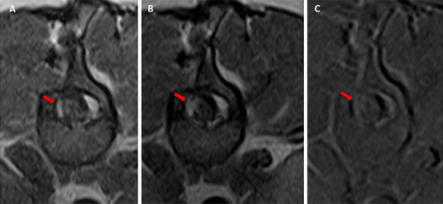 Figure 4. Case 1: Transverse T1-W pre (A) and post-contrast (B) images and subtraction (C) at the level of the surgical site. Note the asymmetrical meningeal thickening and enhancement (red arrow).