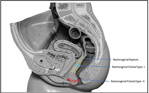 Figure 1 The schematic diagram of the female pelvis (sagittal section) showing the rectovaginal septum (yellow dotted line), type-I rectovaginal fistula (involving rectovaginal septum) (blue color), and type-II rectovaginal fistula (not involving rectovaginal septum) (red color).