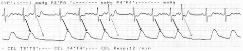 Figure 2. Plethysmography of a patient with frequent PVCs. The arrows show the increase of blood flow in the circulation after each left ventricular contraction. The dotted arrows show the absence of an increased blood flow after a premature ventricular contraction.